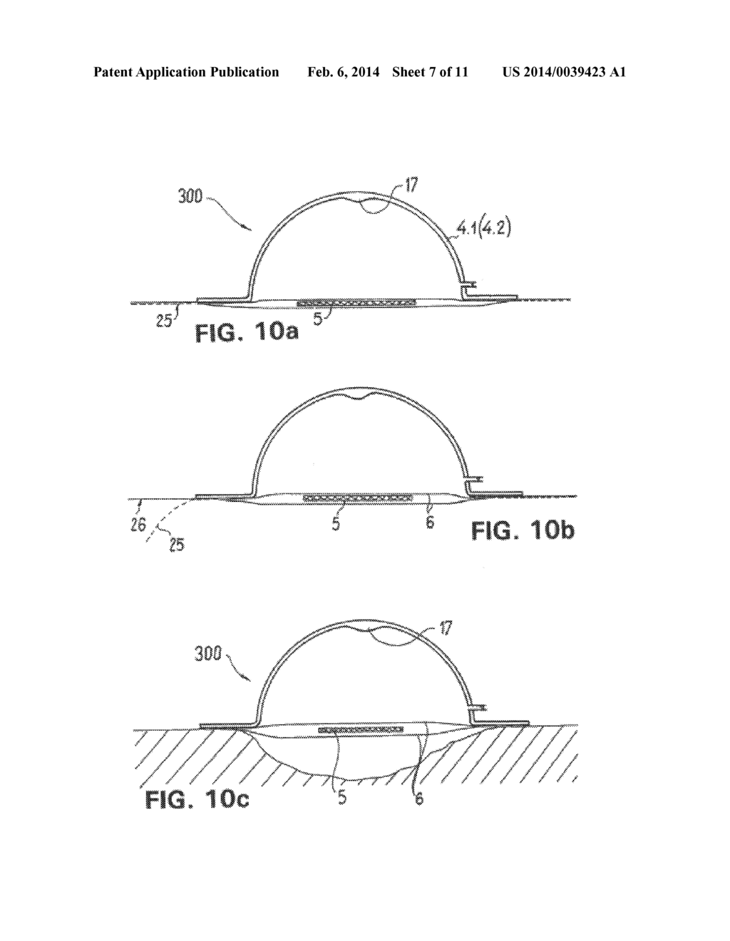 WOUND TREATMENT DEVICE WITH ELASTICALLY DEFORMABLE VACUUM PRODUCING     ELEMENT - diagram, schematic, and image 08