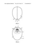 OSTOMY POUCH diagram and image