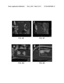 ACUTE BLOOD-BRAIN BARRIER DISRUPTION USING ELECTRICAL ENERGY BASED THERAPY diagram and image