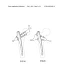 Intramedullary Rod With Spiraling Flutes diagram and image