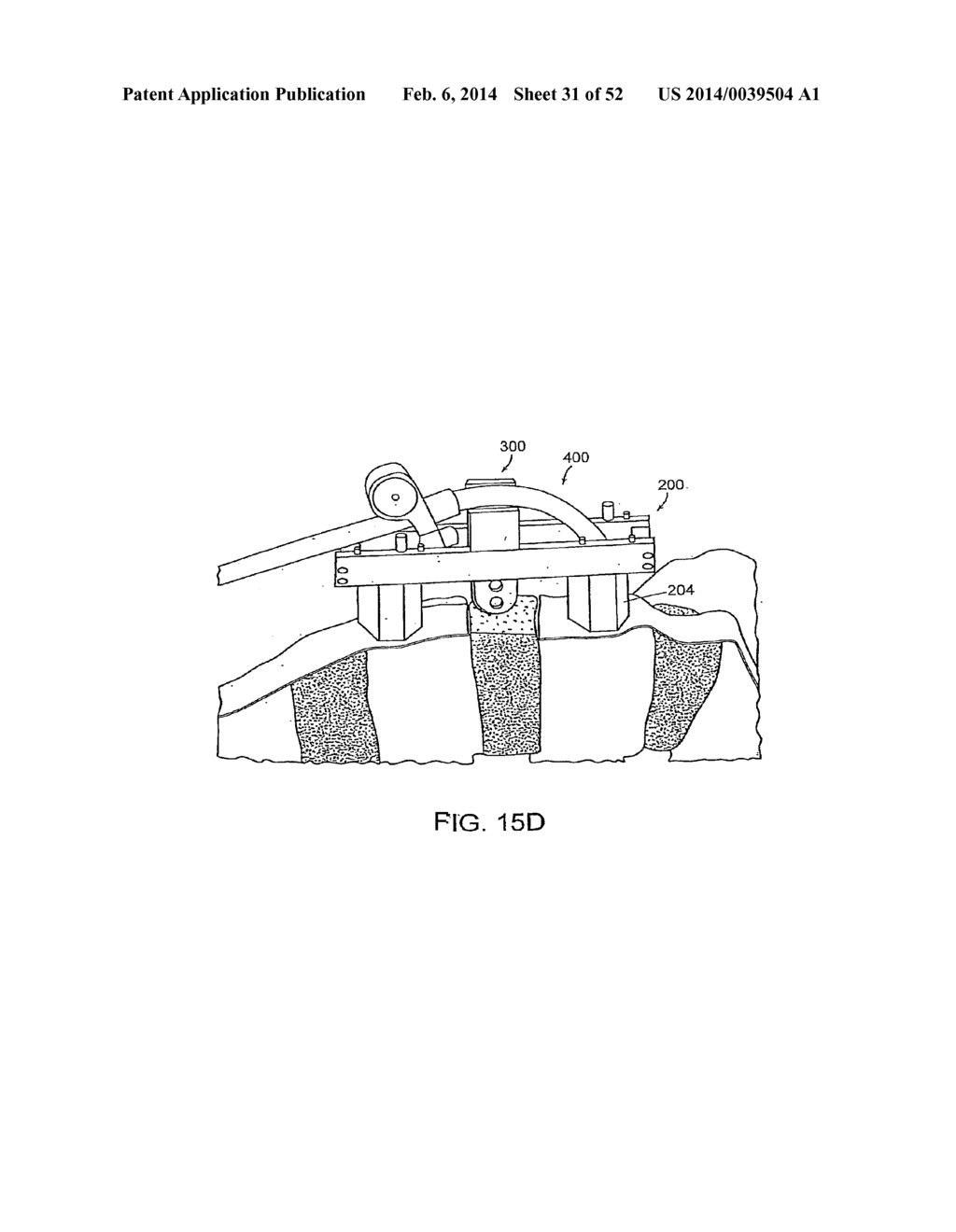 Systems, Devices and Apparatuses for Bony Fixation and Disk Repair and     Replacement and Methods Related Thereto - diagram, schematic, and image 32