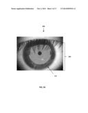 TPS TOOLS AND METHODS FOR THE SURGICAL PLACEMENT OF INTRAOCULAR IMPLANTS diagram and image