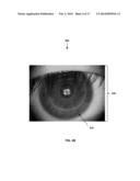 TPS TOOLS AND METHODS FOR THE SURGICAL PLACEMENT OF INTRAOCULAR IMPLANTS diagram and image