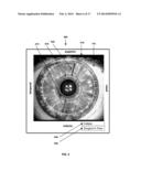 TPS TOOLS AND METHODS FOR THE SURGICAL PLACEMENT OF INTRAOCULAR IMPLANTS diagram and image