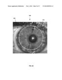 TPS TOOLS AND METHODS FOR THE SURGICAL PLACEMENT OF INTRAOCULAR IMPLANTS diagram and image