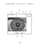 TPS TOOLS AND METHODS FOR THE SURGICAL PLACEMENT OF INTRAOCULAR IMPLANTS diagram and image