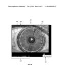 TPS TOOLS AND METHODS FOR THE SURGICAL PLACEMENT OF INTRAOCULAR IMPLANTS diagram and image