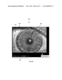 TPS TOOLS AND METHODS FOR THE SURGICAL PLACEMENT OF INTRAOCULAR IMPLANTS diagram and image
