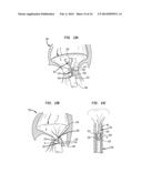 APPARATUS AND METHOD FOR HEART VALVE REPAIR diagram and image