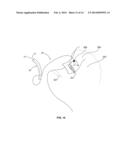 SOFT TISSUE FIXATION DEVICES AND METHODS diagram and image