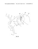 SOFT TISSUE FIXATION DEVICES AND METHODS diagram and image