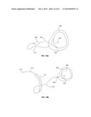 SOFT TISSUE FIXATION DEVICES AND METHODS diagram and image