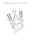 SPINE DEROTATION SYSTEM diagram and image