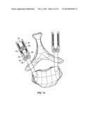 SPINE DEROTATION SYSTEM diagram and image