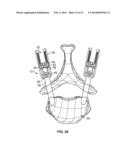 SPINE DEROTATION SYSTEM diagram and image