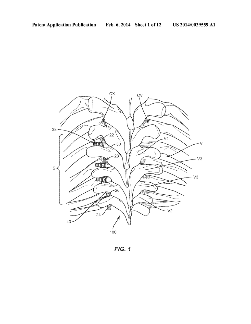 SYSTEM AND METHOD FOR CORRECTION OF A SPINAL DISORDER - diagram, schematic, and image 02