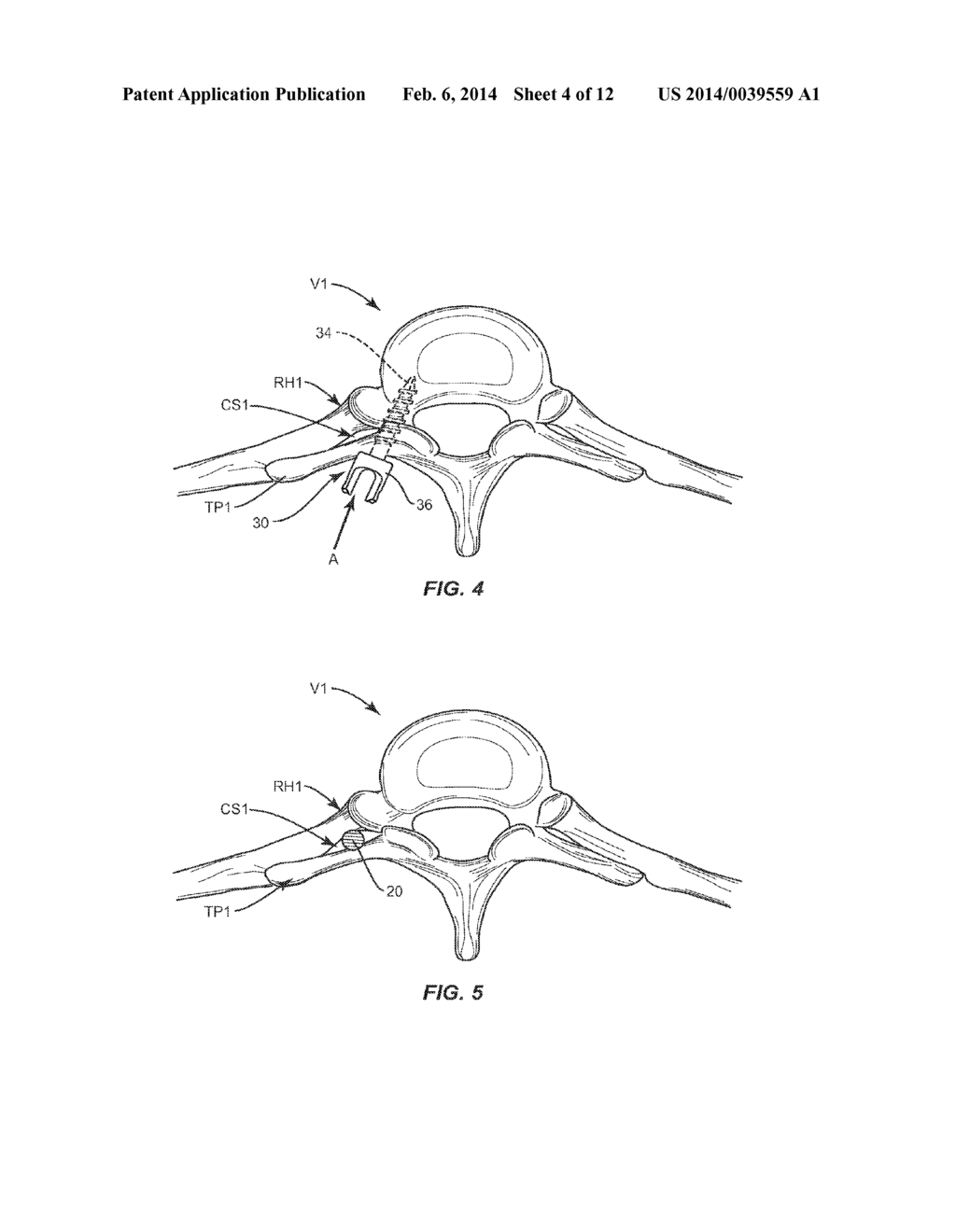 SYSTEM AND METHOD FOR CORRECTION OF A SPINAL DISORDER - diagram, schematic, and image 05