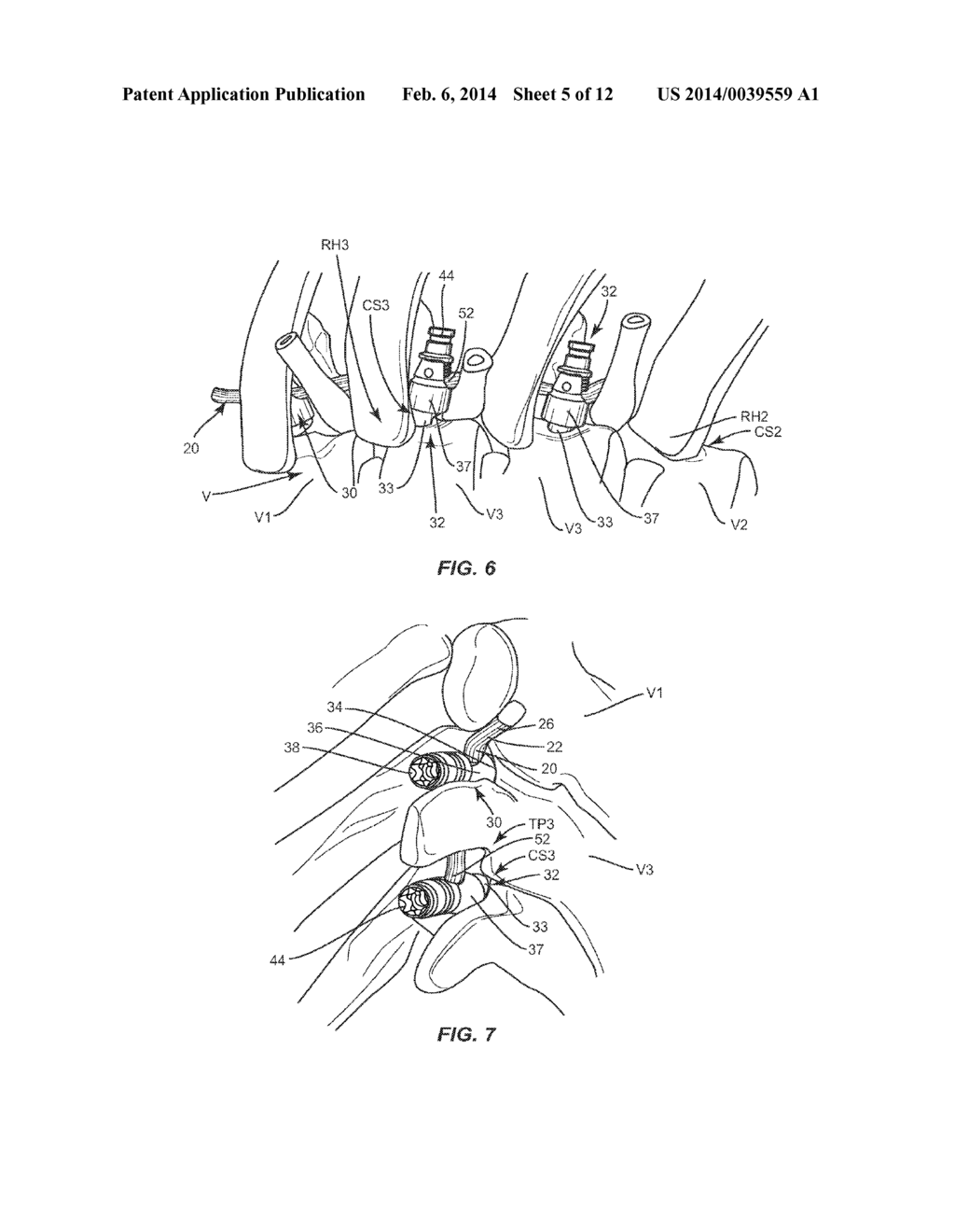 SYSTEM AND METHOD FOR CORRECTION OF A SPINAL DISORDER - diagram, schematic, and image 06