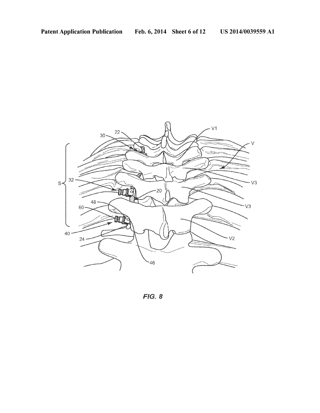 SYSTEM AND METHOD FOR CORRECTION OF A SPINAL DISORDER - diagram, schematic, and image 07