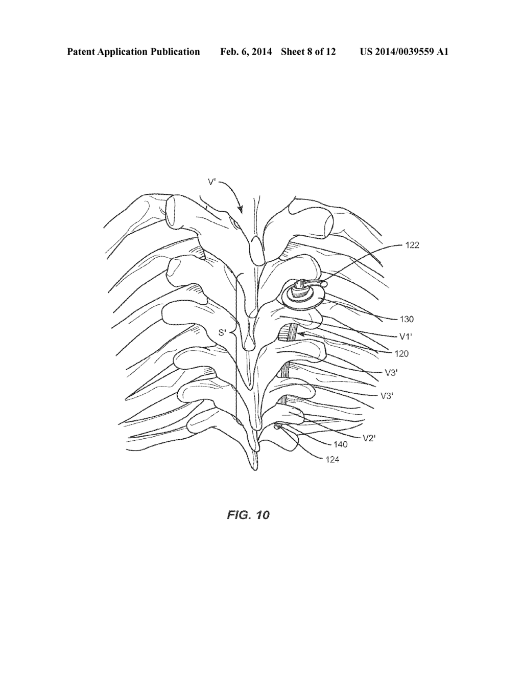 SYSTEM AND METHOD FOR CORRECTION OF A SPINAL DISORDER - diagram, schematic, and image 09