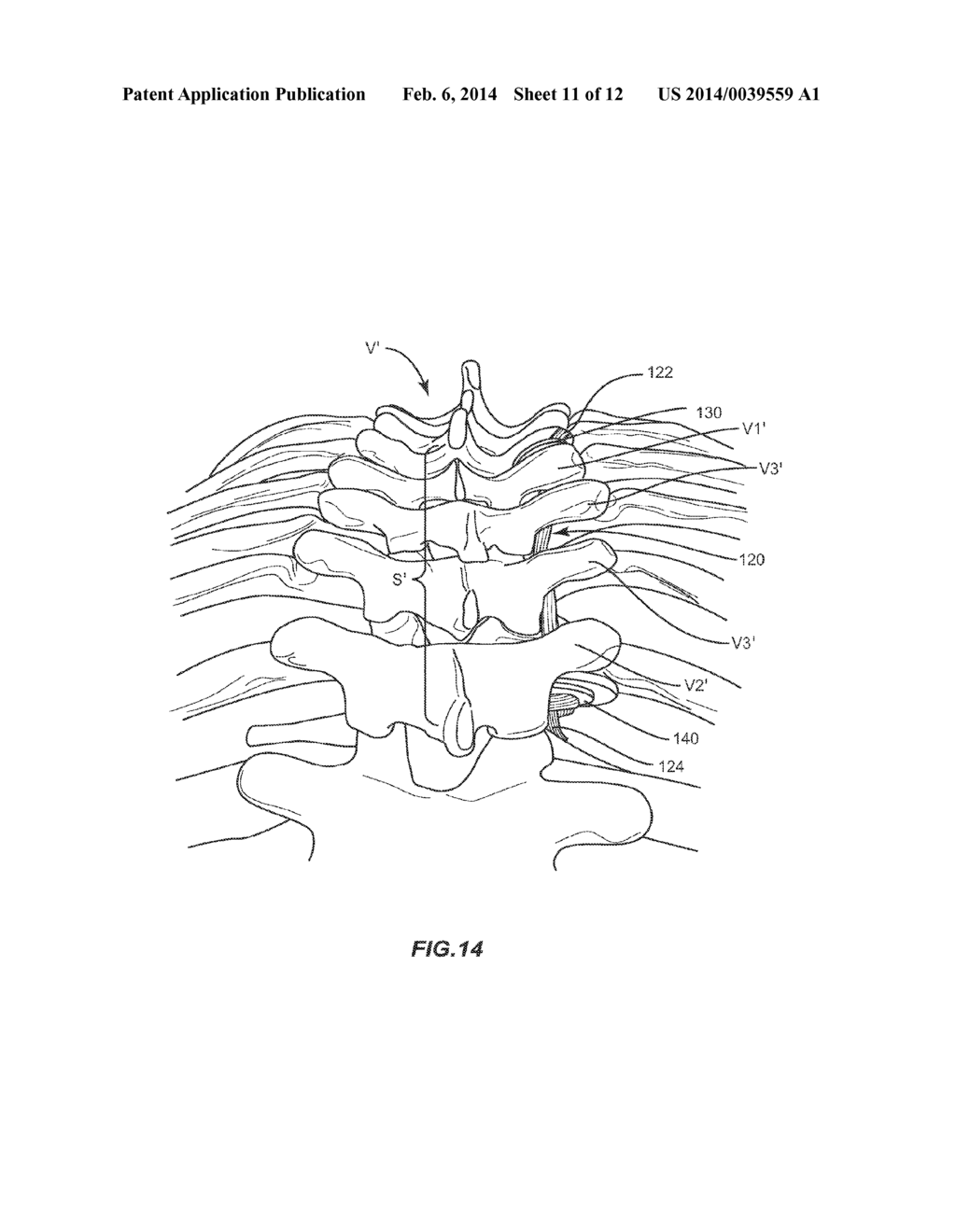 SYSTEM AND METHOD FOR CORRECTION OF A SPINAL DISORDER - diagram, schematic, and image 12