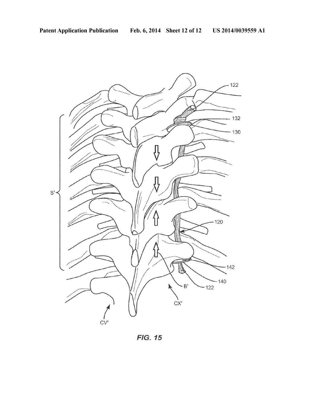 SYSTEM AND METHOD FOR CORRECTION OF A SPINAL DISORDER - diagram, schematic, and image 13