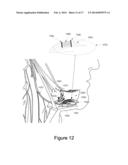 Method for Controlling Energy Delivery as a Function of Degree of Coupling diagram and image