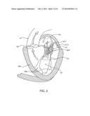 TRANSCATHETER MITRAL VALVE PROSTHESIS diagram and image