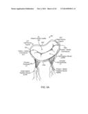 TRANSCATHETER MITRAL VALVE PROSTHESIS diagram and image