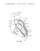 TRANSCATHETER MITRAL VALVE PROSTHESIS diagram and image