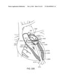 TRANSCATHETER MITRAL VALVE PROSTHESIS diagram and image