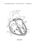 TRANSCATHETER MITRAL VALVE PROSTHESIS diagram and image