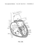 TRANSCATHETER MITRAL VALVE PROSTHESIS diagram and image