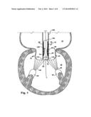 METHODS FOR REPLACING A CARDIAC VALVE diagram and image