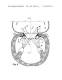 METHODS FOR REPLACING A CARDIAC VALVE diagram and image