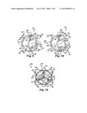 METHODS FOR REPLACING A CARDIAC VALVE diagram and image