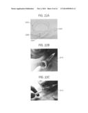 Stent-Valves For Valve Replacement and Associated Methods and Systems for     Surgery diagram and image