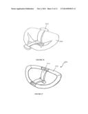 DEVICES AND METHODS FOR SURGICAL AND PERCUTANEOUS REPAIR OF HEART VALVE     LESIONS diagram and image