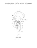 Method And Apparatus For Acetabular Reconstruction diagram and image