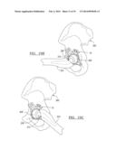 Method And Apparatus For Acetabular Reconstruction diagram and image
