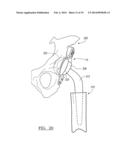 Method And Apparatus For Acetabular Reconstruction diagram and image