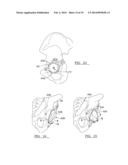 Method And Apparatus For Acetabular Reconstruction diagram and image