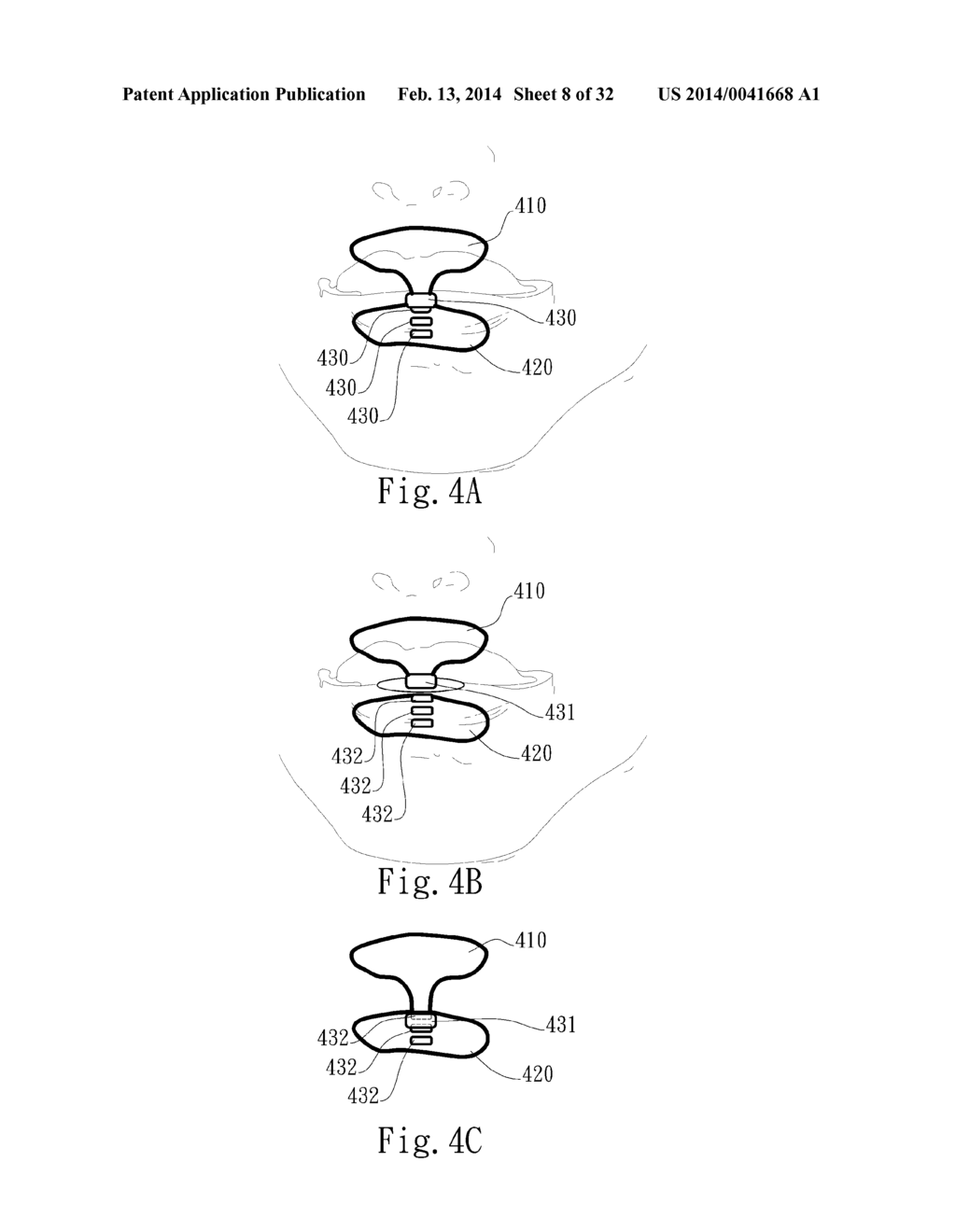 ADJUSTABLE ORAL INTERFACE AND METHOD TO MAINTAIN UPPER AIRWAY PATENCY - diagram, schematic, and image 09