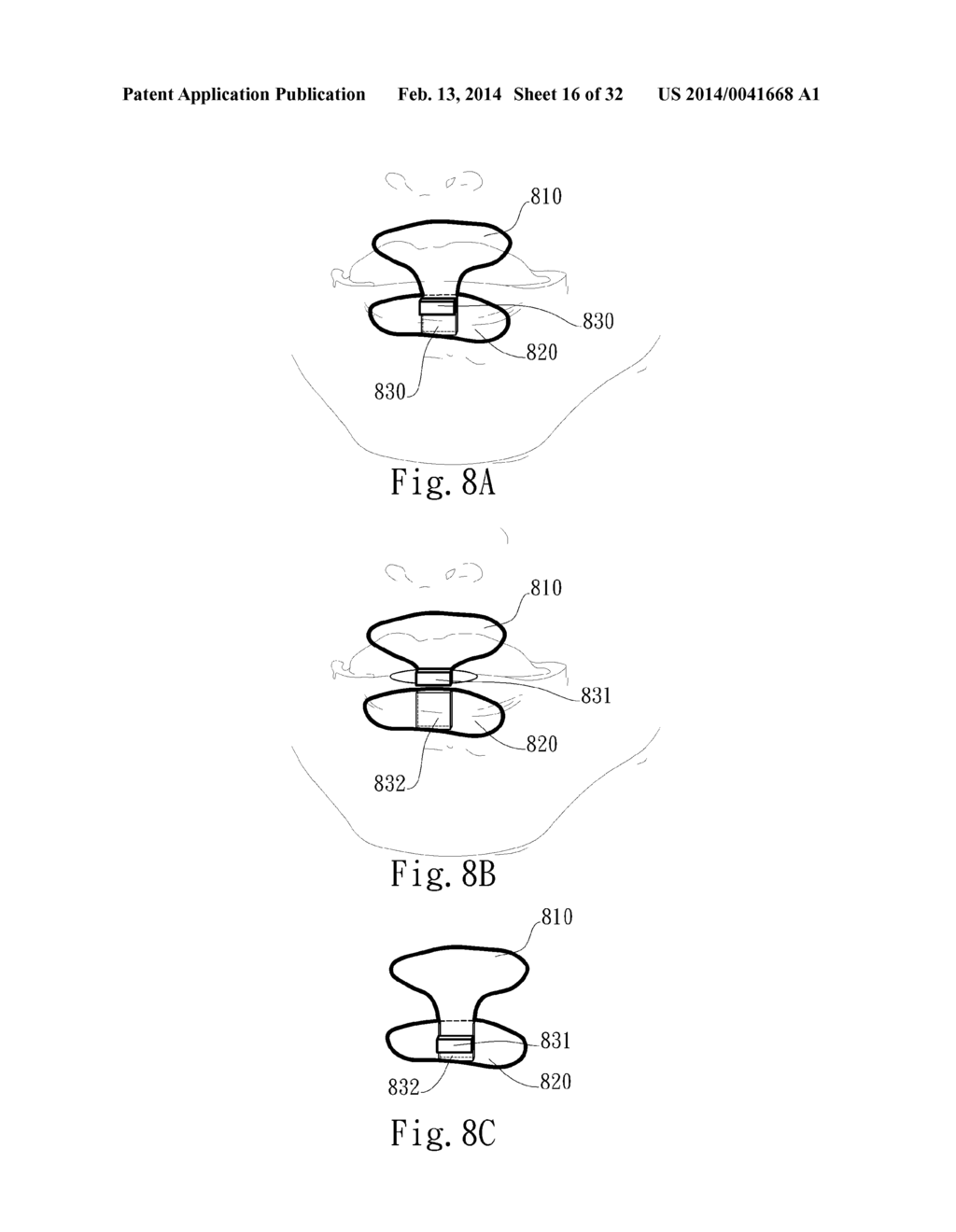 ADJUSTABLE ORAL INTERFACE AND METHOD TO MAINTAIN UPPER AIRWAY PATENCY - diagram, schematic, and image 17