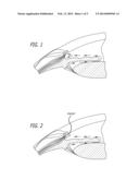 INTRACAMERAL SUSTAINED RELEASE THERAPEUTIC AGENT IMPLANTS diagram and image