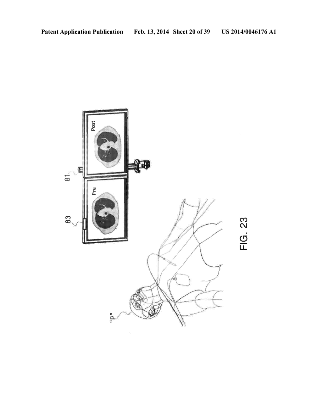 MICROWAVE ABLATION CATHETER AND METHOD OF UTILIZING THE SAME - diagram, schematic, and image 21