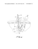 SURGICAL RETRIEVAL APPARATUS diagram and image