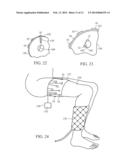 ACOUSTIC THERAPY DEVICE diagram and image