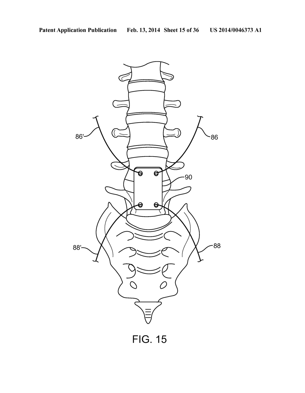 SPINAL STABILIZATION SYSTEM AND METHOD - diagram, schematic, and image 16