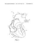 IMPLANTABLE MEDICAL DEVICE RESPONSIVE TO MRI INDUCED CAPTURE THRESHOLD     CHANGES diagram and image